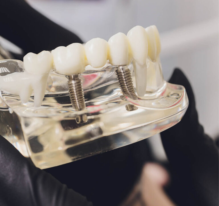 Implanty zębów implanty zębów lubin